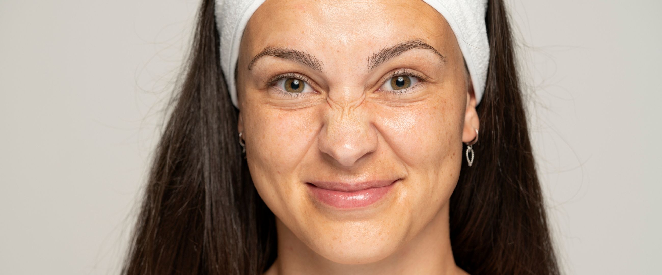 Bunny lines on face