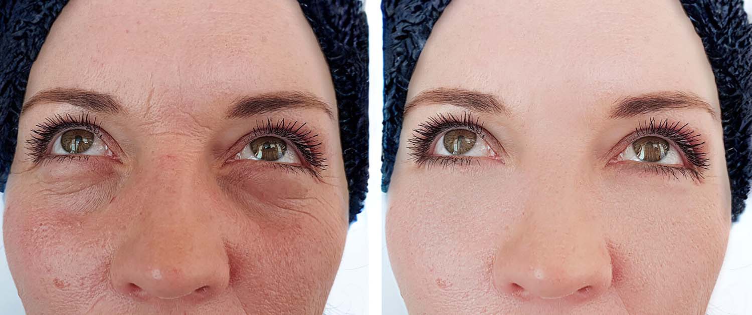 Tear Trough Filler Bruising - before and after