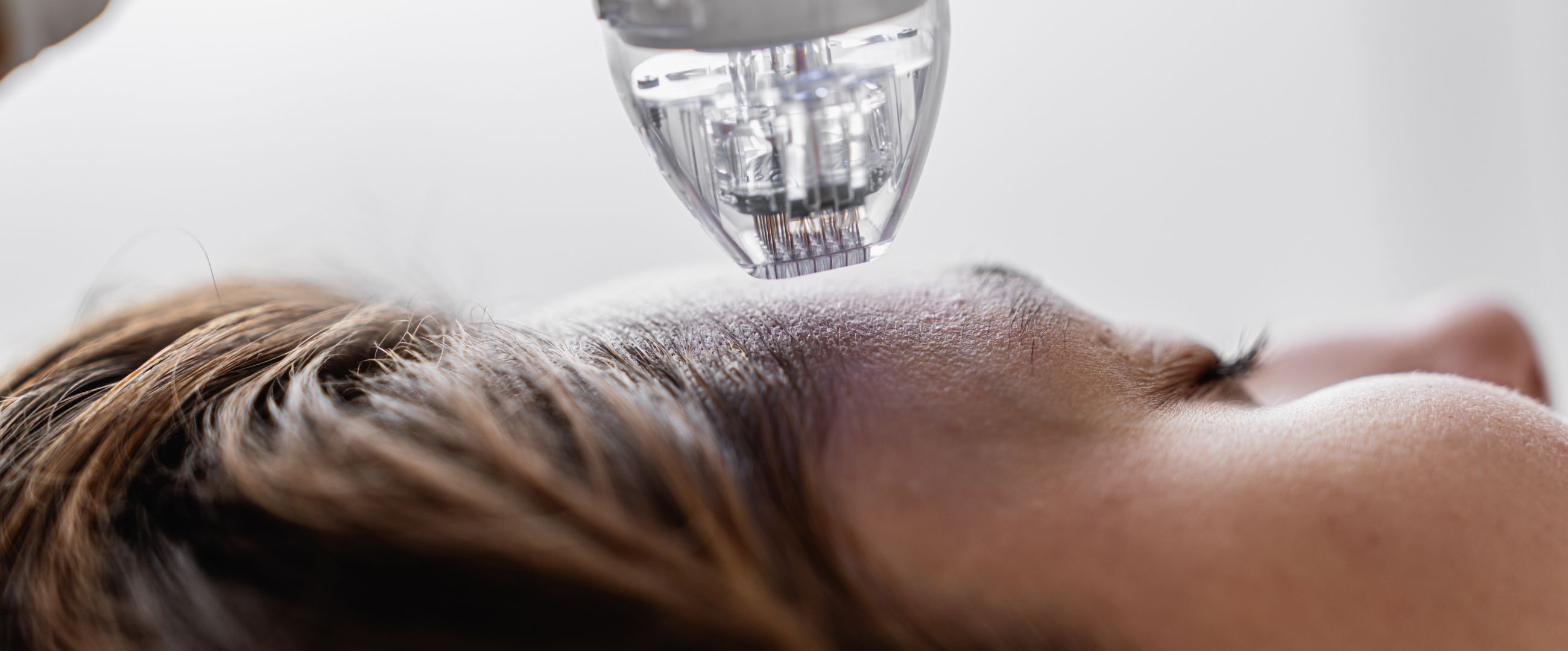 Upclose microneedling treatment on skin