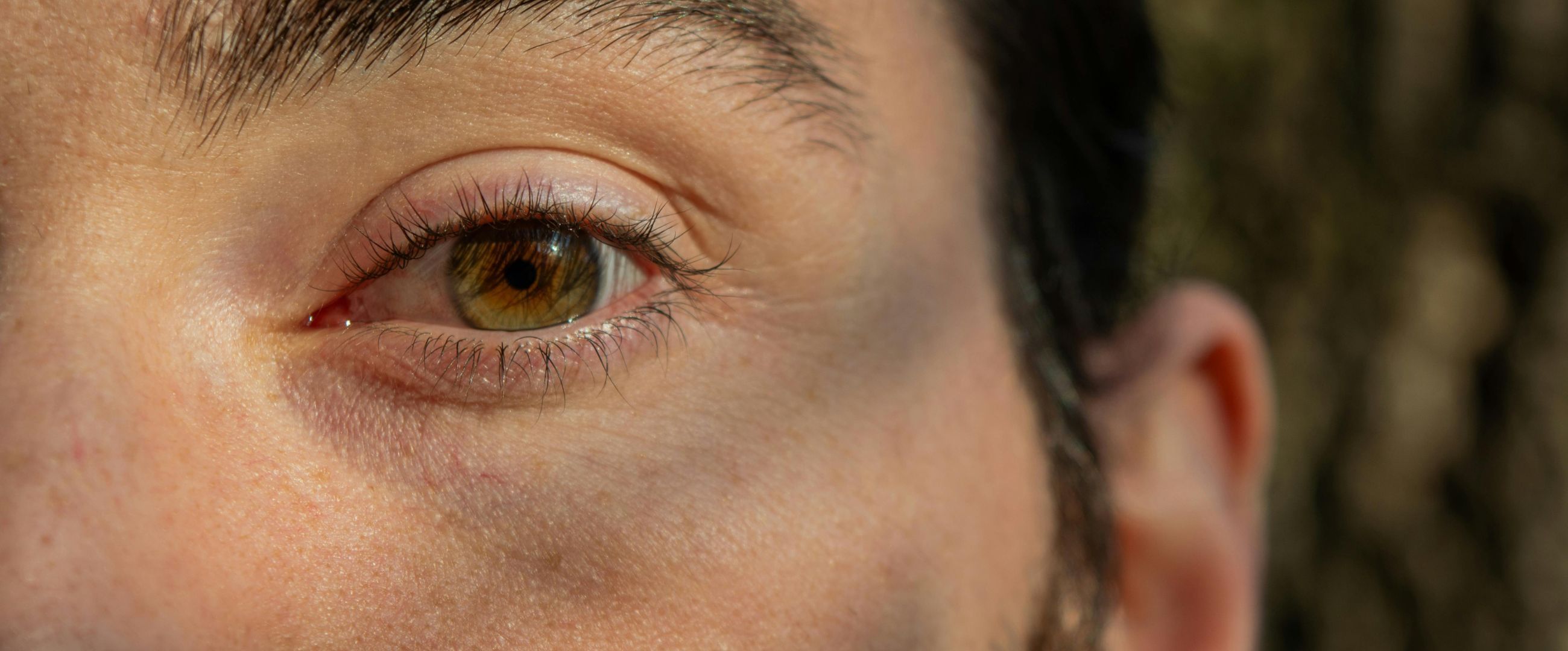 What Causes Tear Troughs and Under Eye Hollows