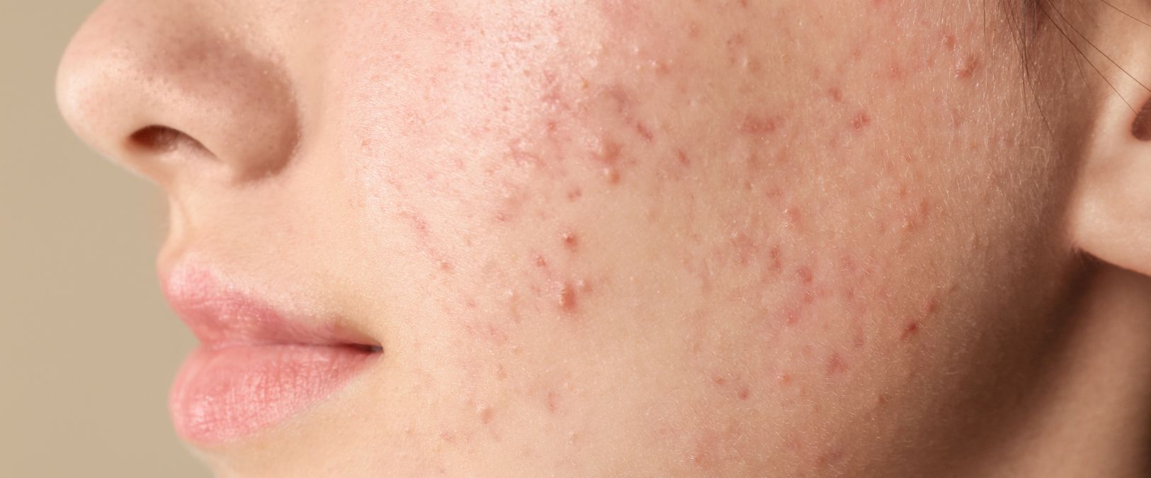 acne prone skin close up