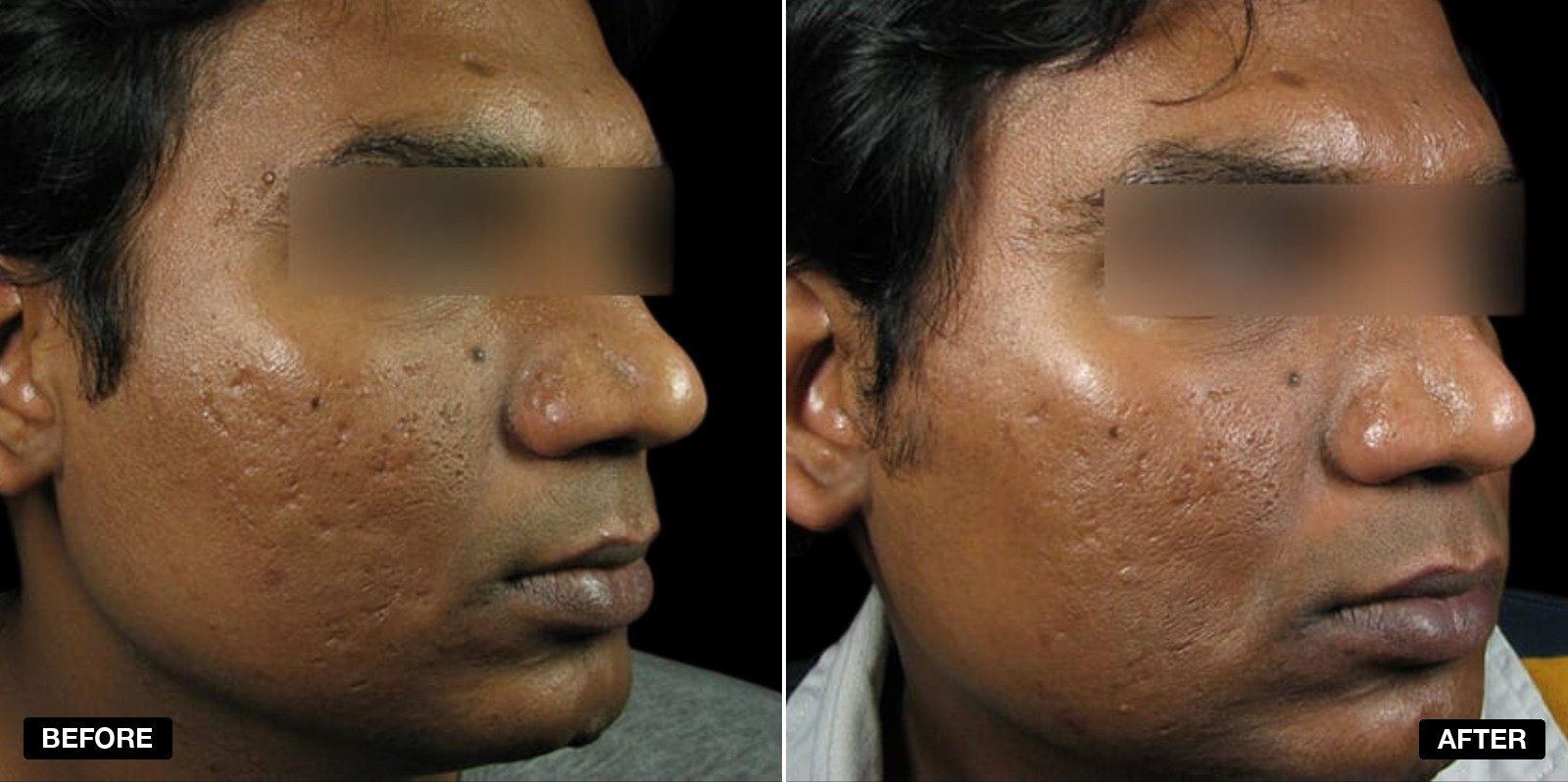 Acne scarring transformations - patient case 2 of 4 at PHI Clinic London