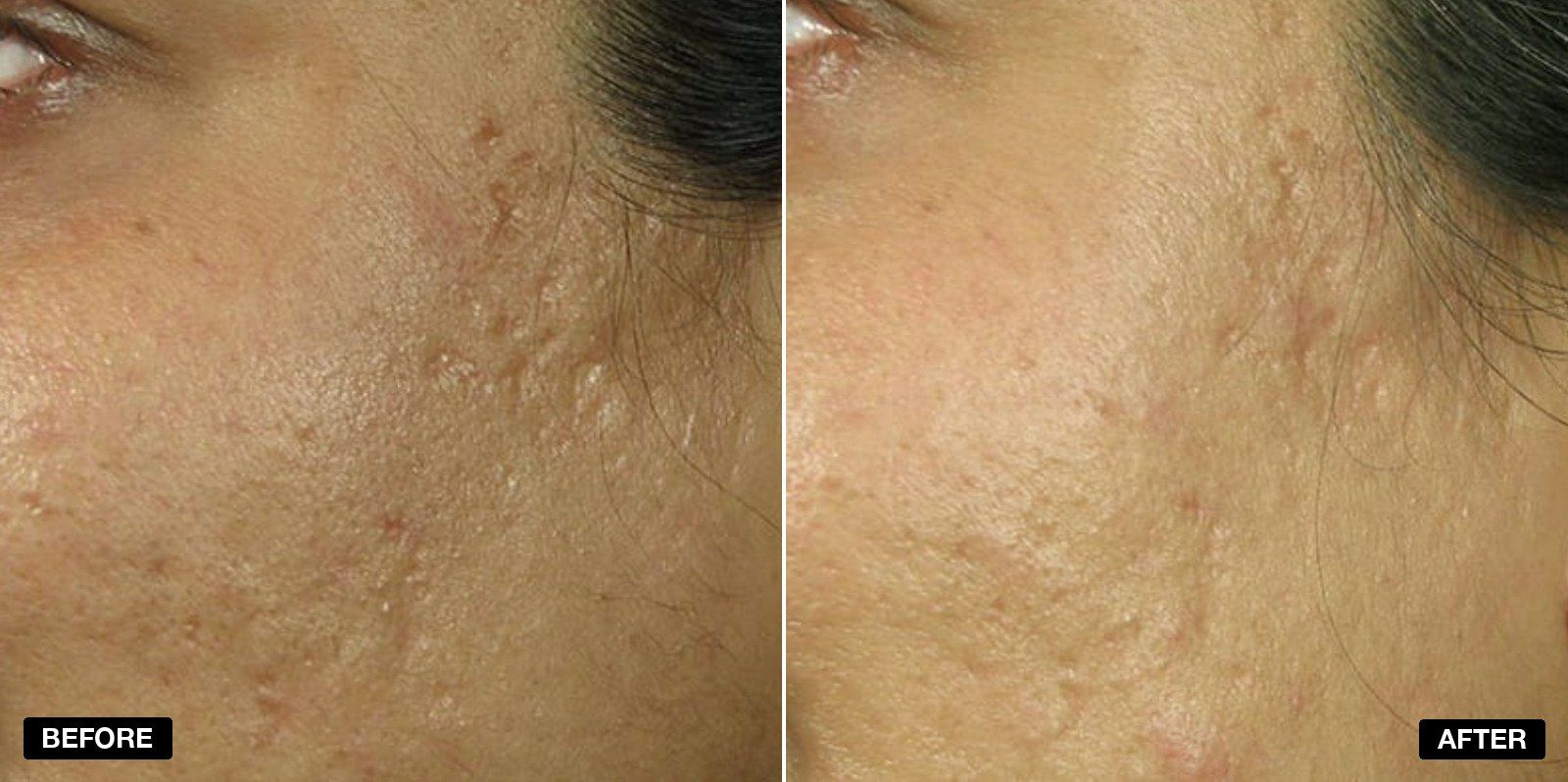 Acne scarring transformations - patient case 3 of 4 at PHI Clinic London