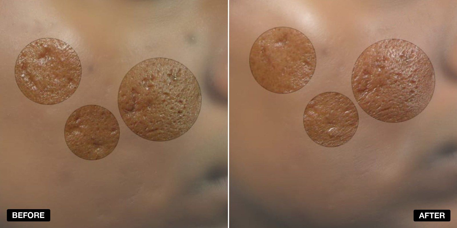 Acne scarring transformations - patient case 4 of 4 at PHI Clinic London