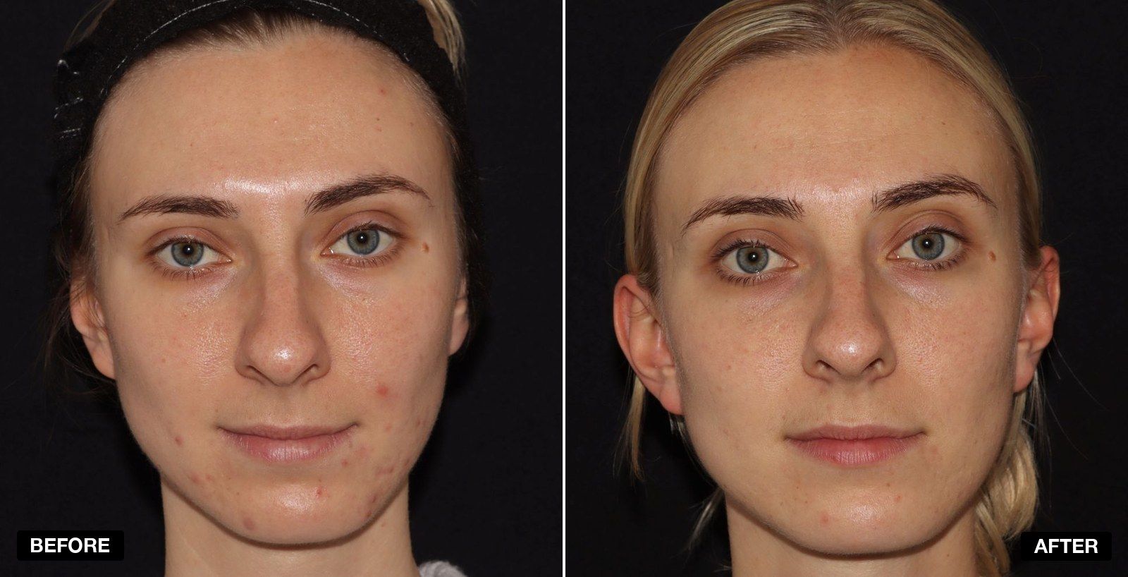 Acne treatment before and after - patient case 1 of 9 at PHI Clinic London