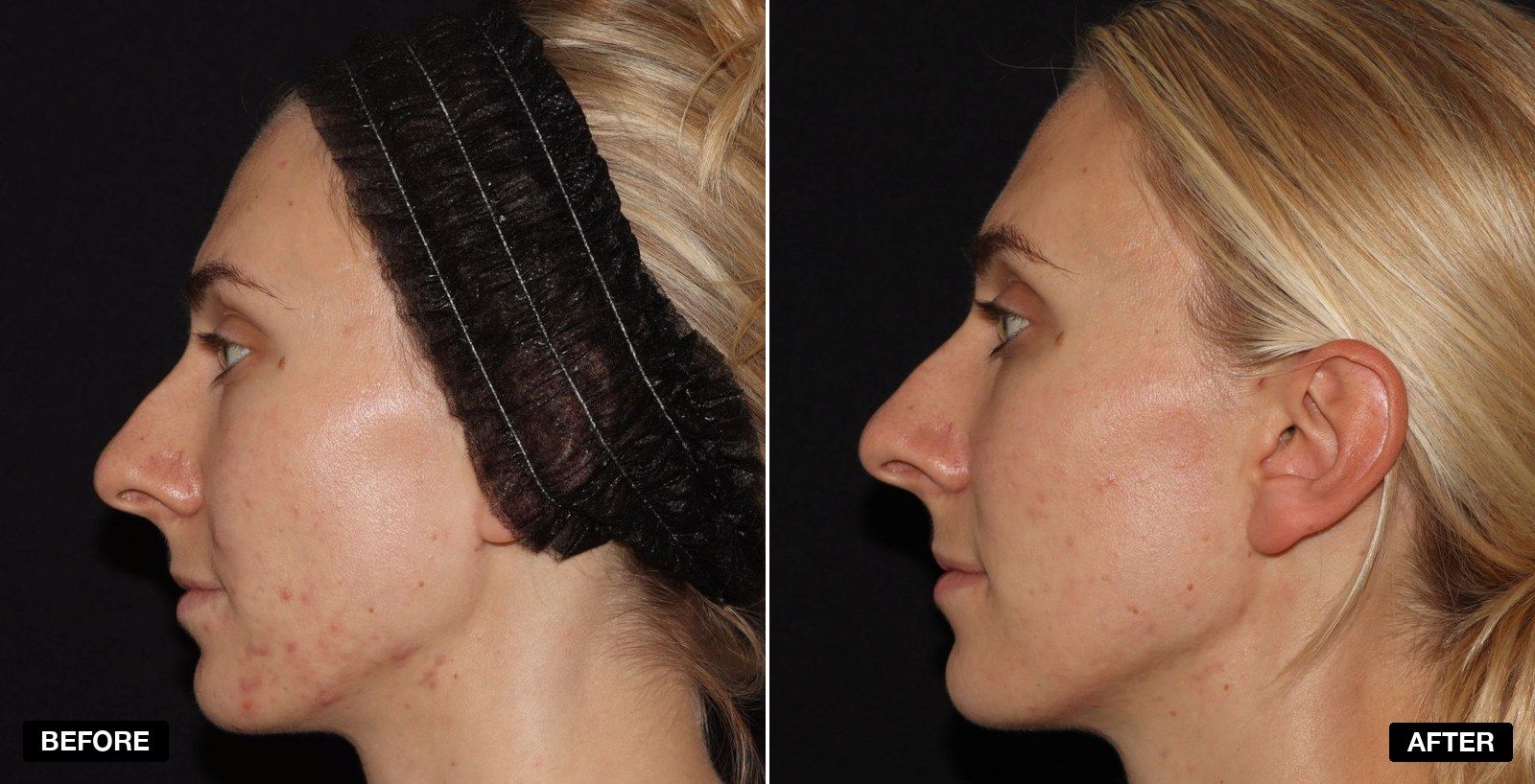 Acne treatment before and after - patient case 2 of 9 at PHI Clinic London