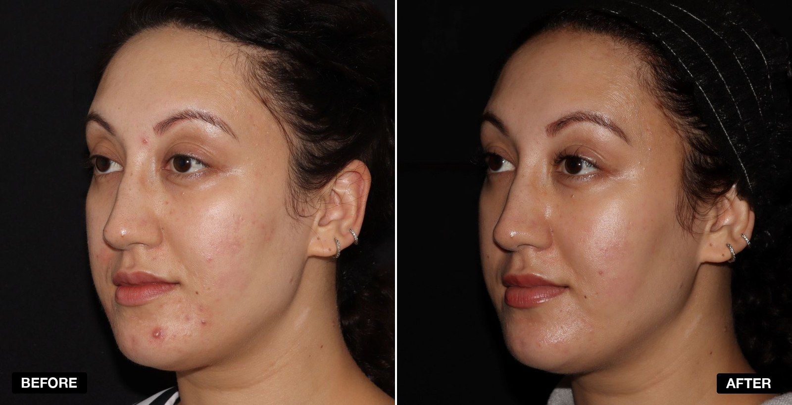 Acne treatment before and after - patient case 3 of 9 at PHI Clinic London