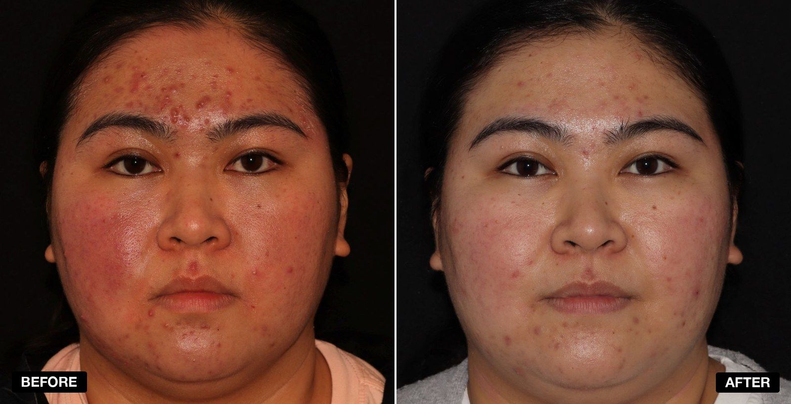 Acne treatment before and after - patient case 4 of 9 at PHI Clinic London
