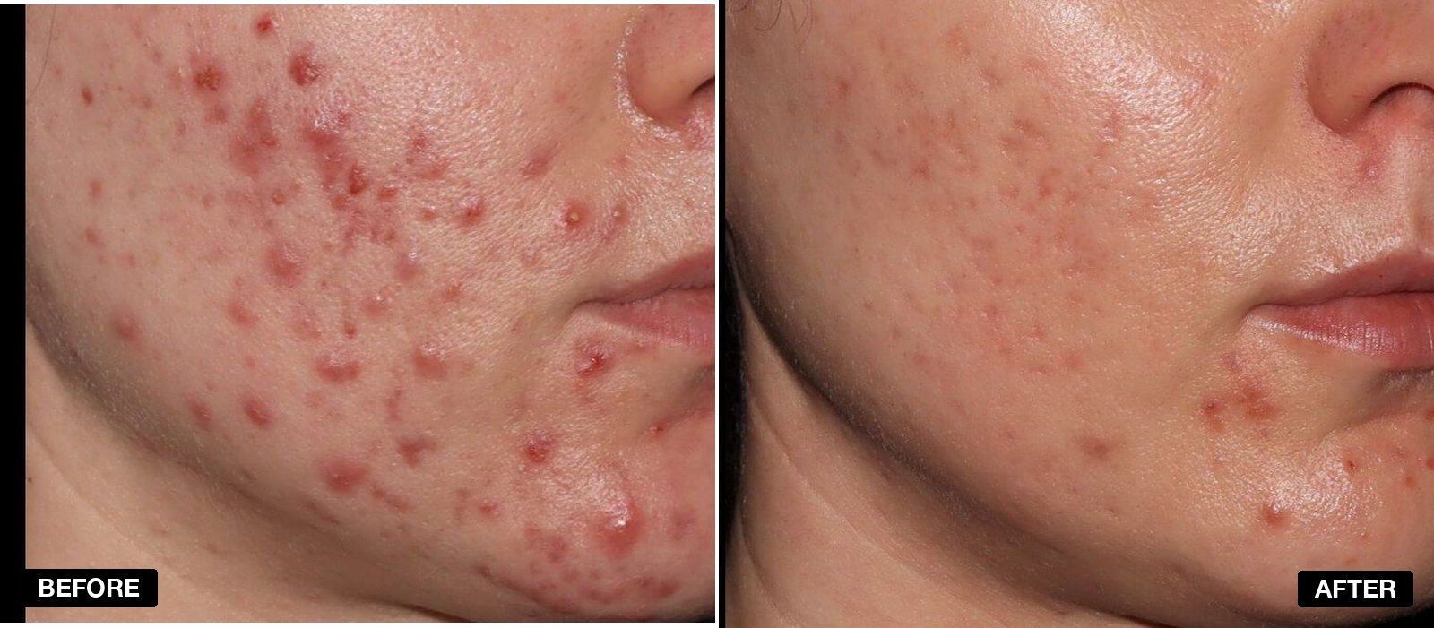 Acne treatment before and after - patient case 6 of 9 at PHI Clinic London