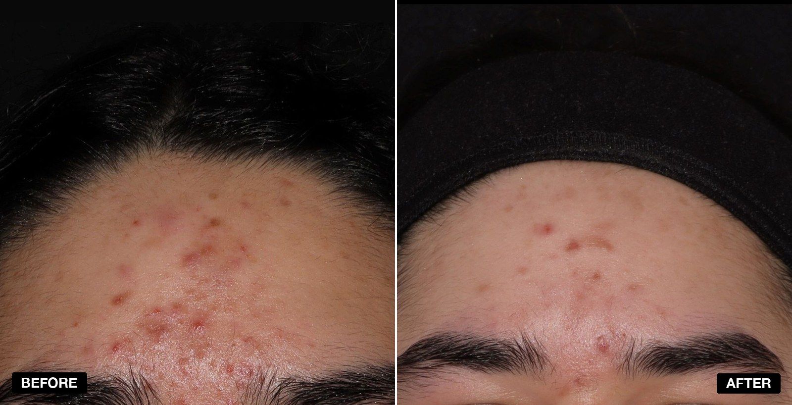 Acne treatment before and after - patient case 7 of 9 at PHI Clinic London