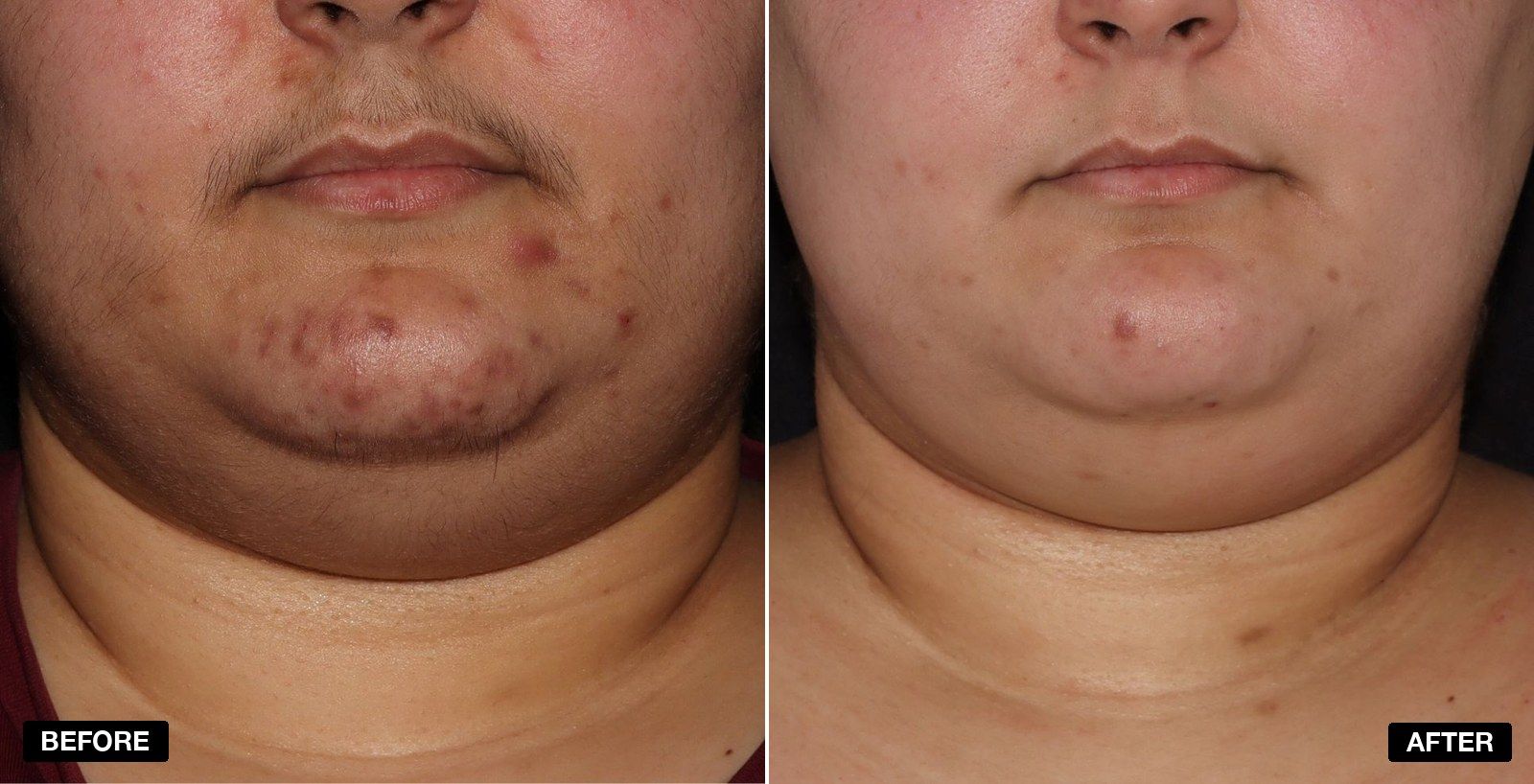 Acne treatment before and after - patient case 8 of 9 at PHI Clinic London