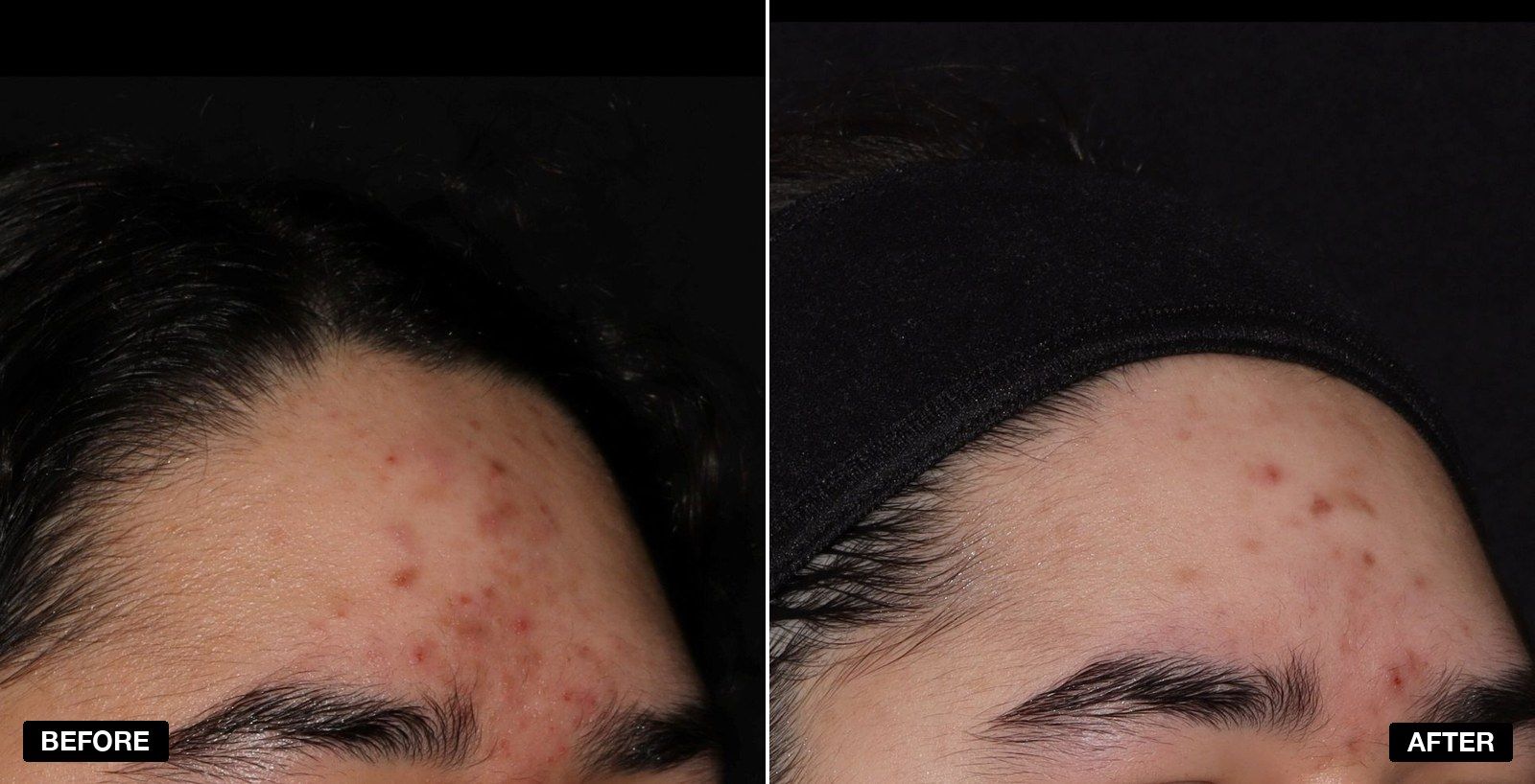 Acne treatment before and after - patient case 9 of 9 at PHI Clinic London