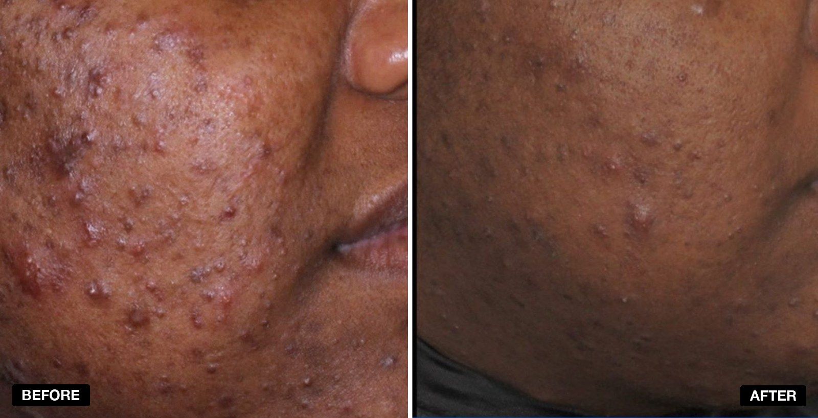 Acne treatment before and after 3 months - patient case 1 of 3 at PHI Clinic London