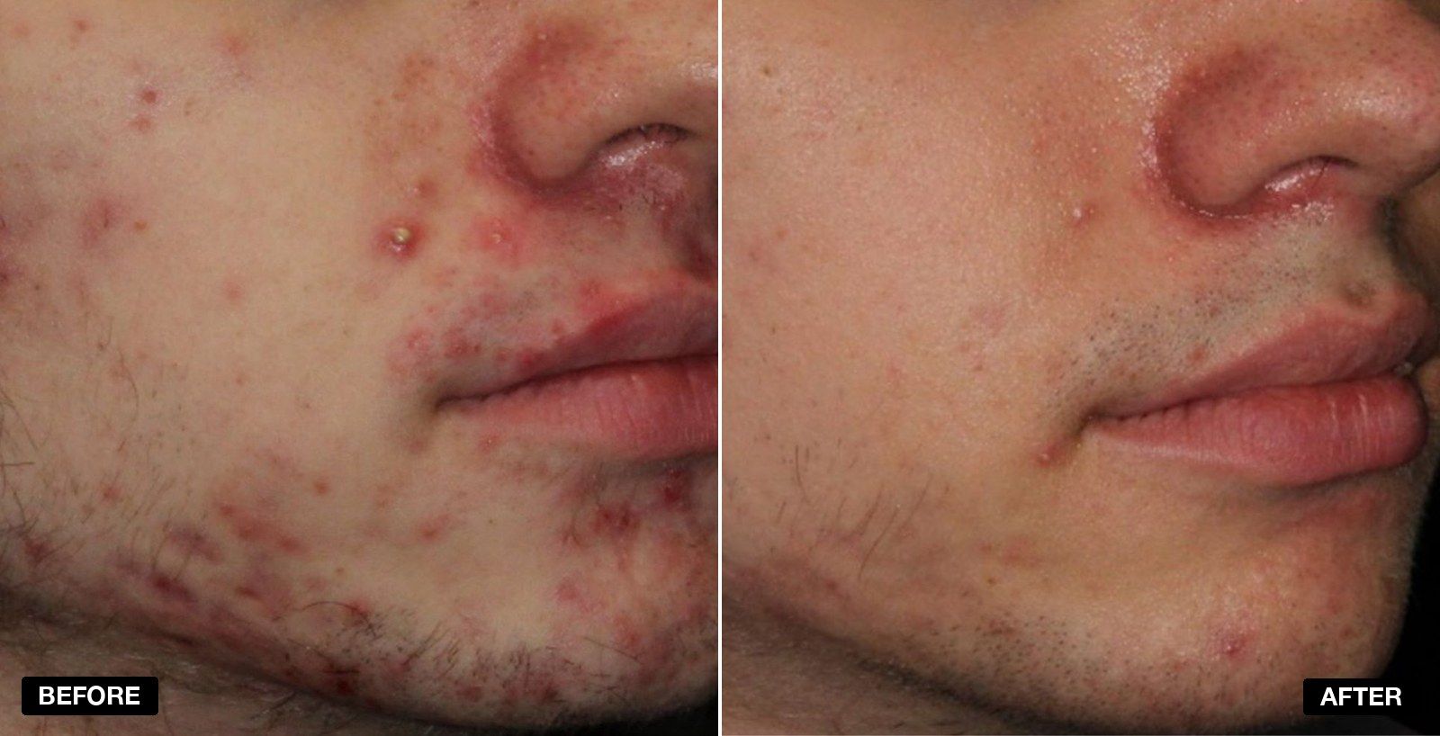 Acne treatment before and after 3 months - patient case 2 of 3 at PHI Clinic London