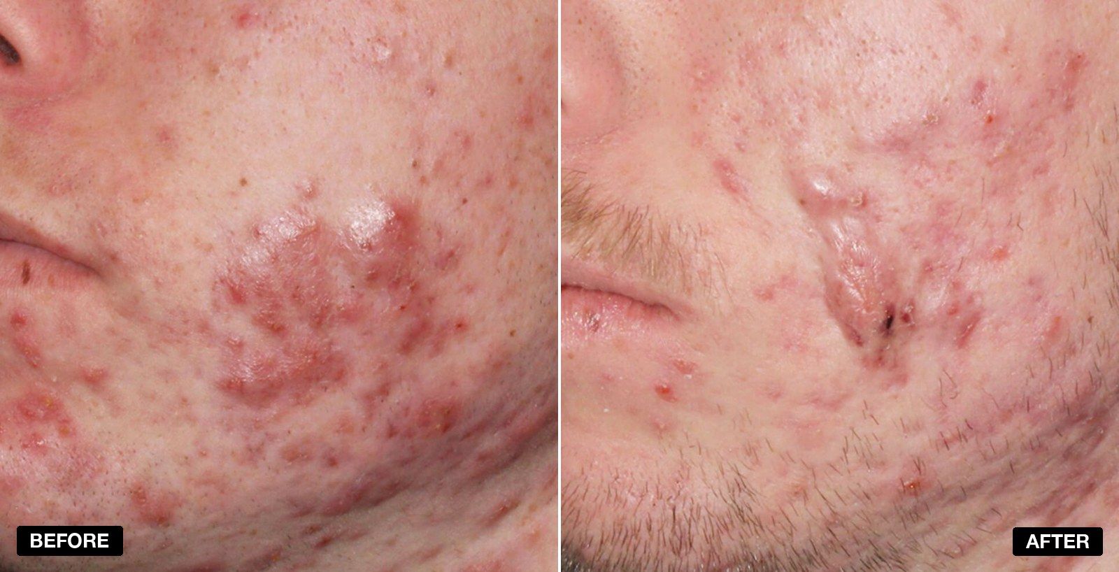Acne treatment before and after 3 months - patient case 3 of 3 at PHI Clinic London
