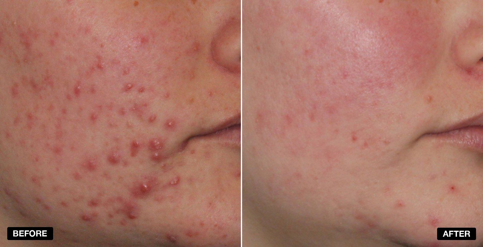 Acne treatment before and after 6 months - patient case 3 of 6 at PHI Clinic London