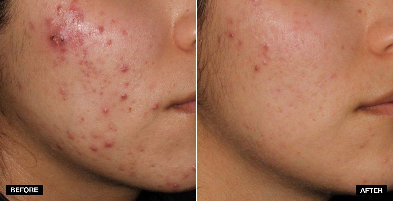 Acne treatment before and after 6 months - patient case 4 of 6 at PHI Clinic London