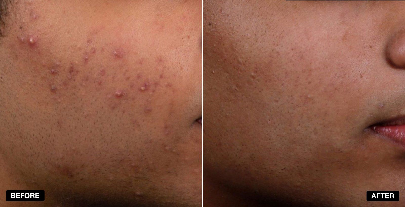 Acne treatment before and after 6 months - patient case 5 of 6 at PHI Clinic London
