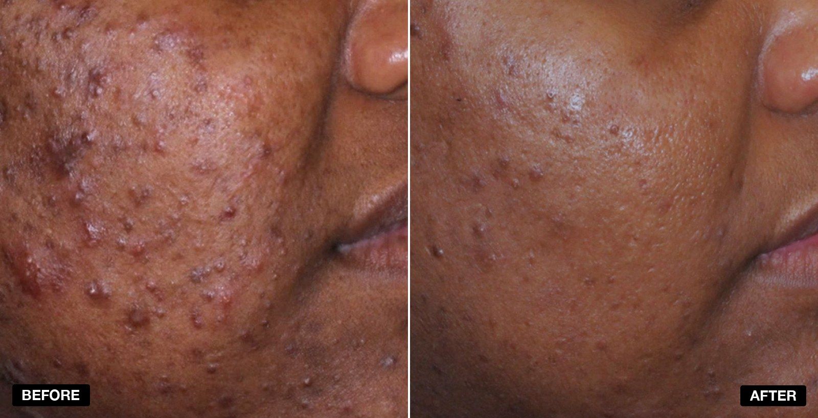 Acne treatment before and after 6 months - patient case 6 of 6 at PHI Clinic London