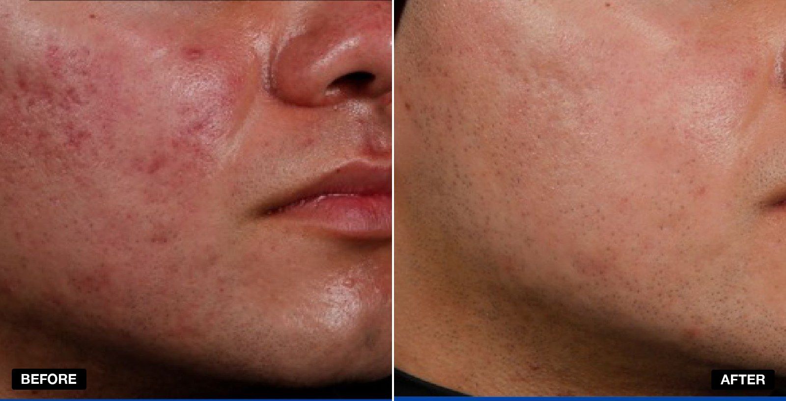 Acne treatment before and after 6 to 12 months - patient case 1 of 3 at PHI Clinic London
