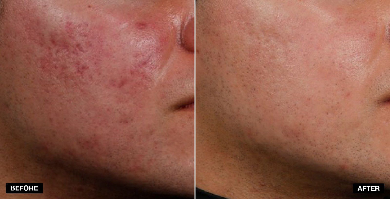 Acne treatment before and after 6 to 12 months - patient case 2 of 3 at PHI Clinic London