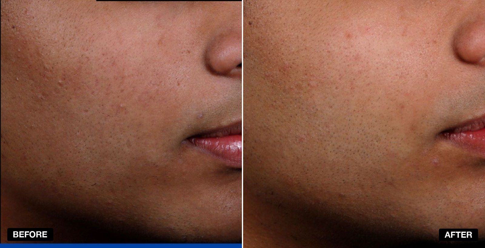 Acne treatment before and after 6 to 12 months - patient case 3 of 3 at PHI Clinic London