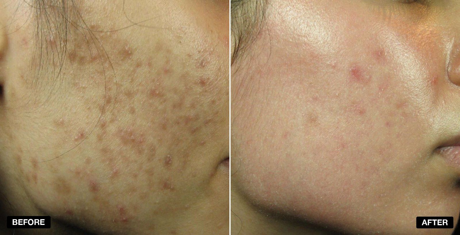 Acne treatment transformations - patient case 1 of 3 at PHI Clinic London