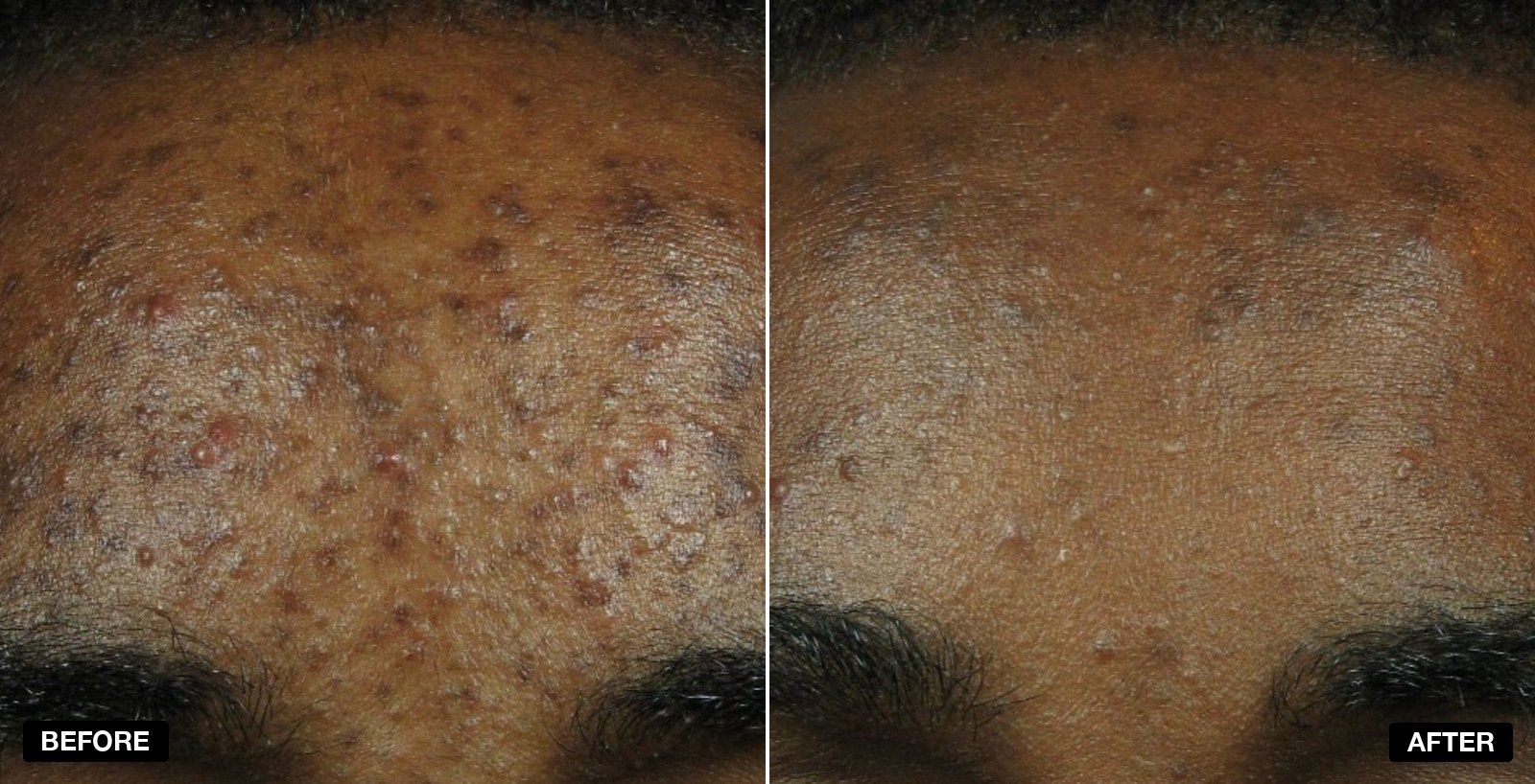 Acne treatment transformations - patient case 2 of 3 at PHI Clinic London