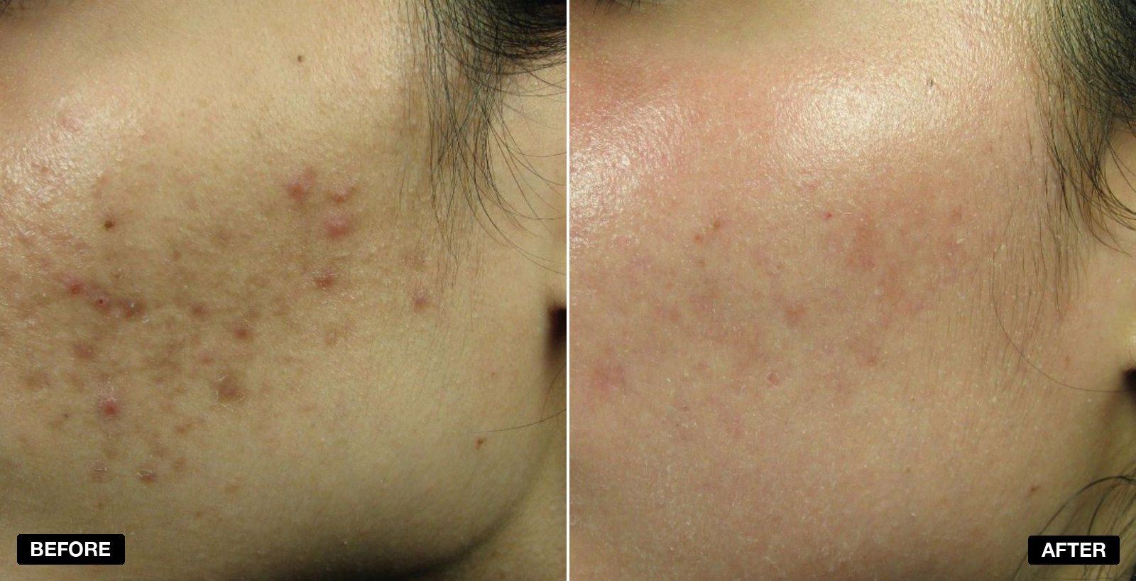 Acne treatment transformations - patient case 3 of 3 at PHI Clinic London