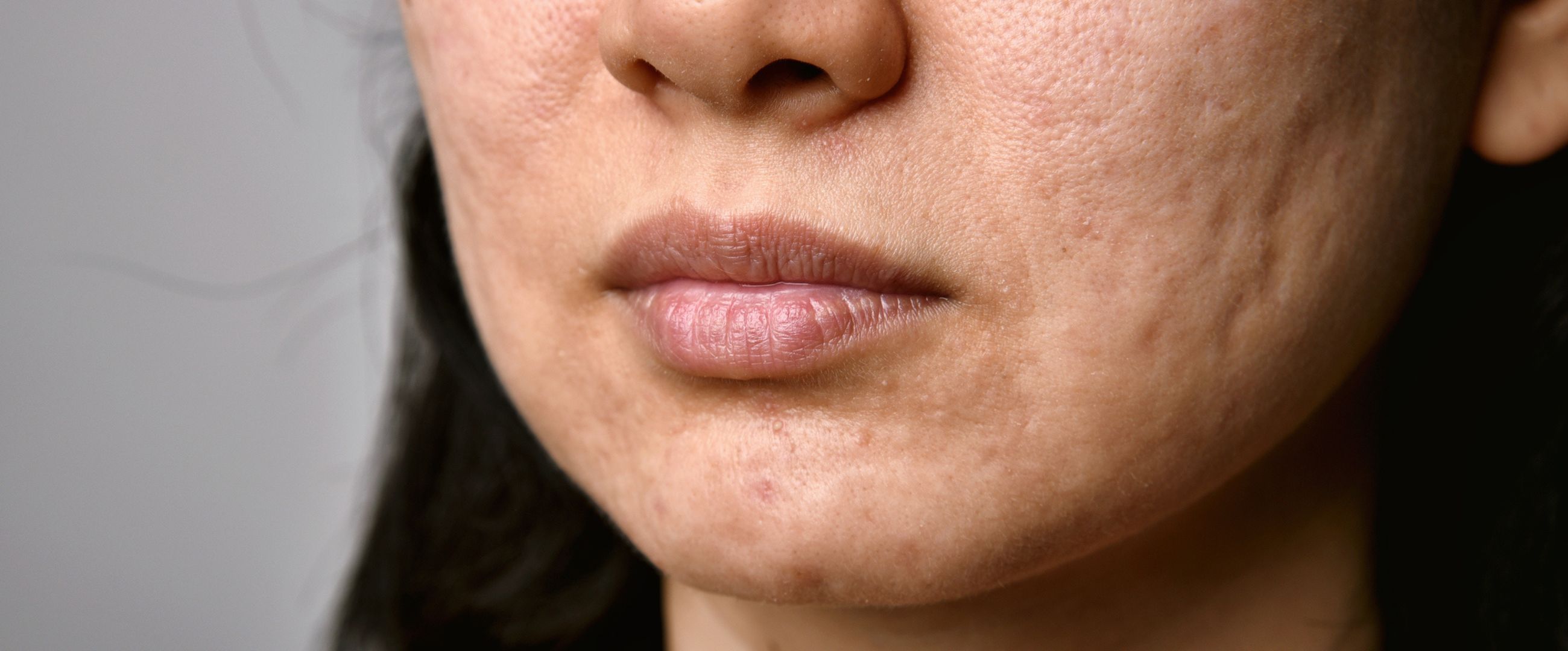 asian woman with acne scars and wrinkles