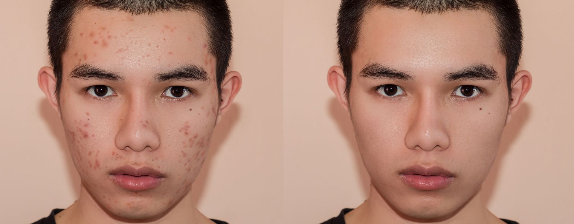 aviclear-laser-best-for-acne-prone-skin london