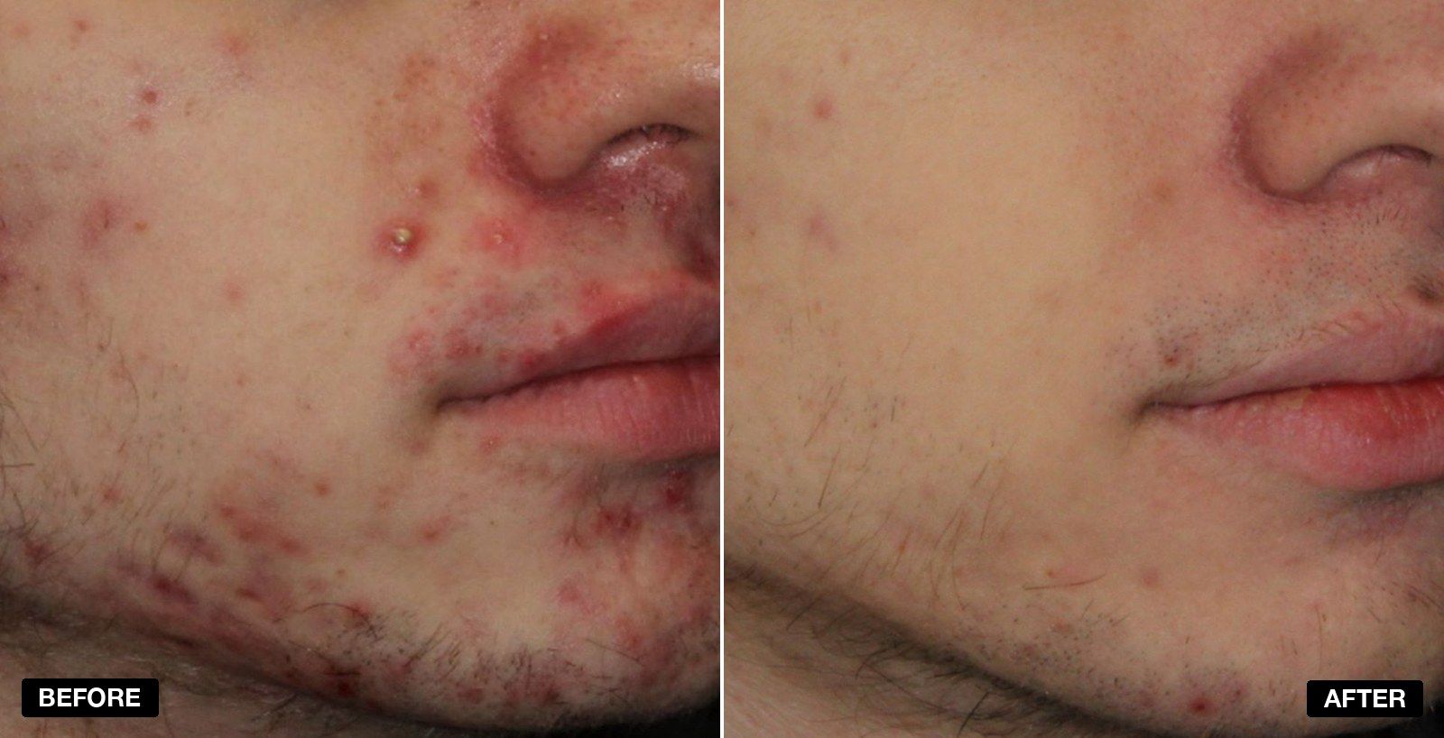 AviClear transformations - patient case 1 of 2 at PHI Clinic London