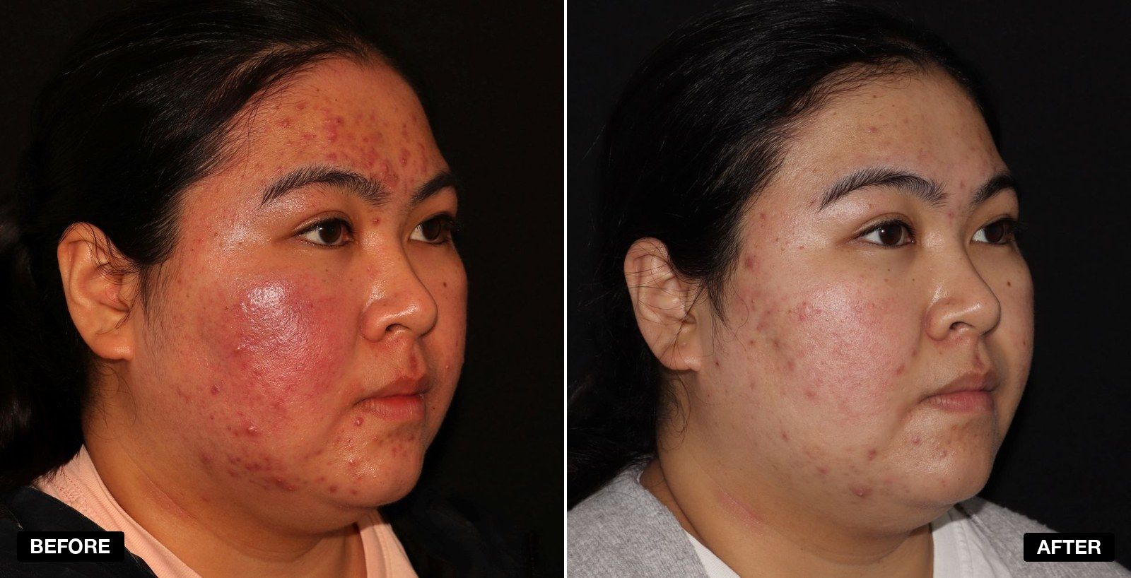 AviClear transformations - patient case 2 of 2 at PHI Clinic London