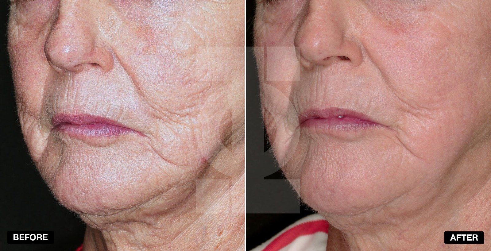 Laser resurfacing results - patient case 1 of 1 at PHI Clinic London