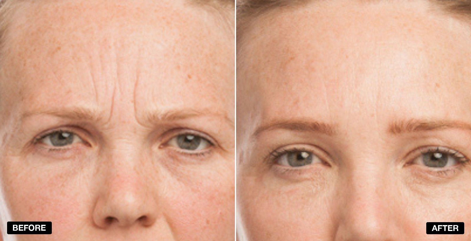 Before and after frown lines - patient case 2 of 2 at PHI Clinic London