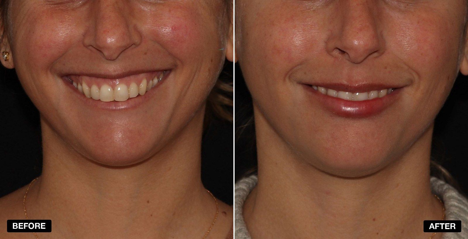Before and after gummy smile - patient case 1 of 1 at PHI Clinic London