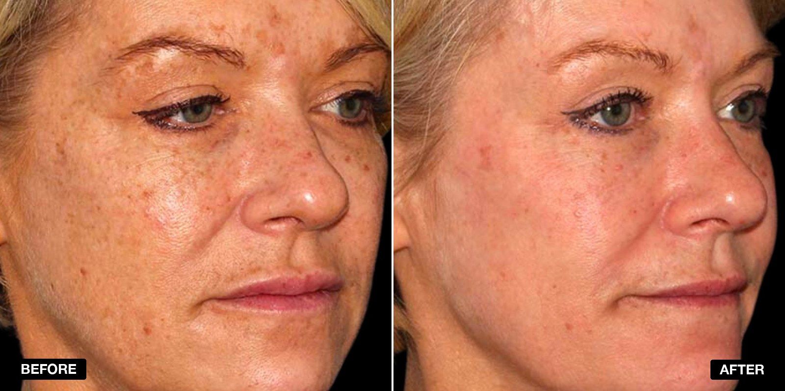Before and after skin care treatments - patient case 1 of 5 at PHI Clinic London