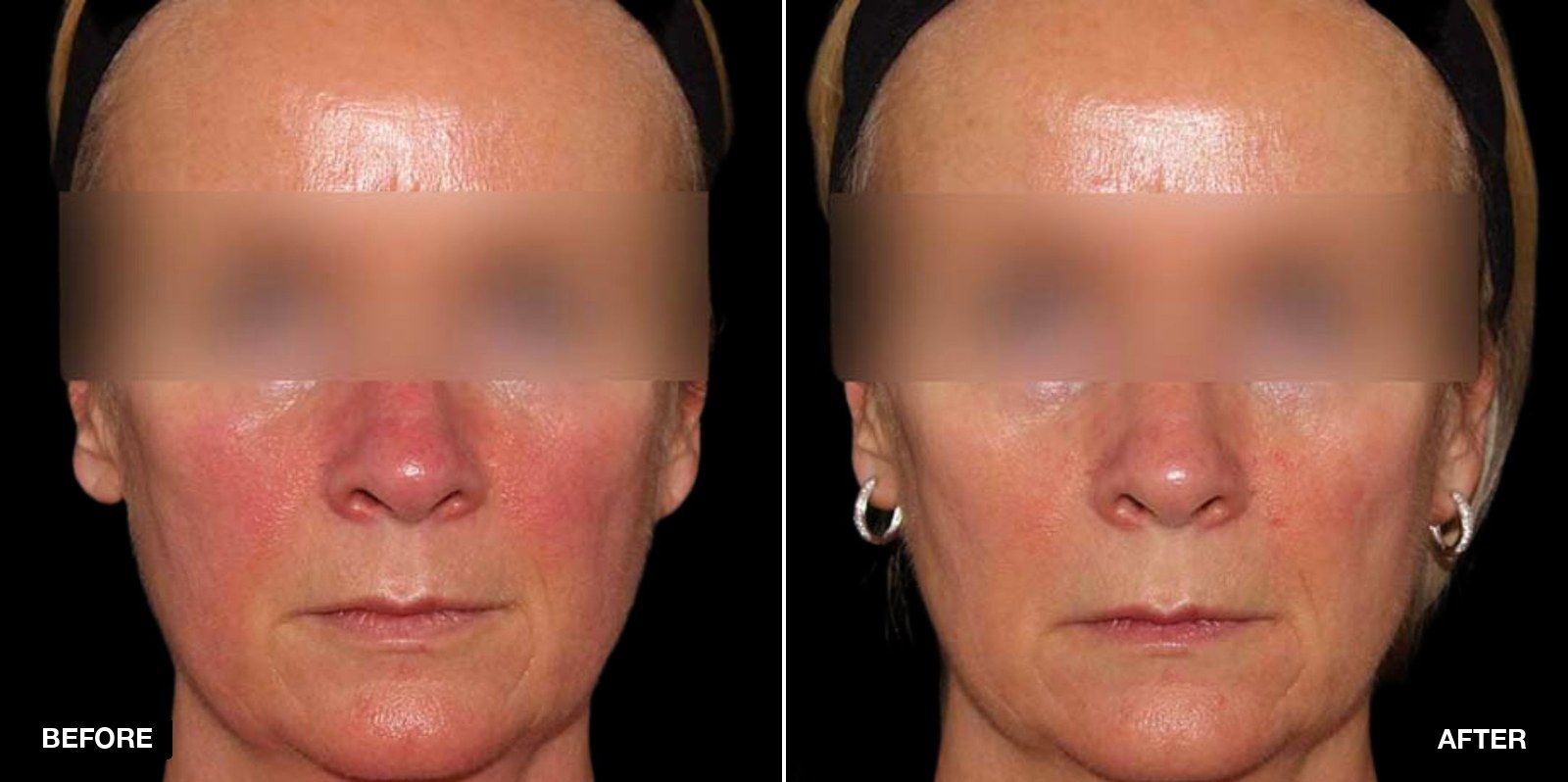 Before and after skin care treatments - patient case 3 of 5 at PHI Clinic London