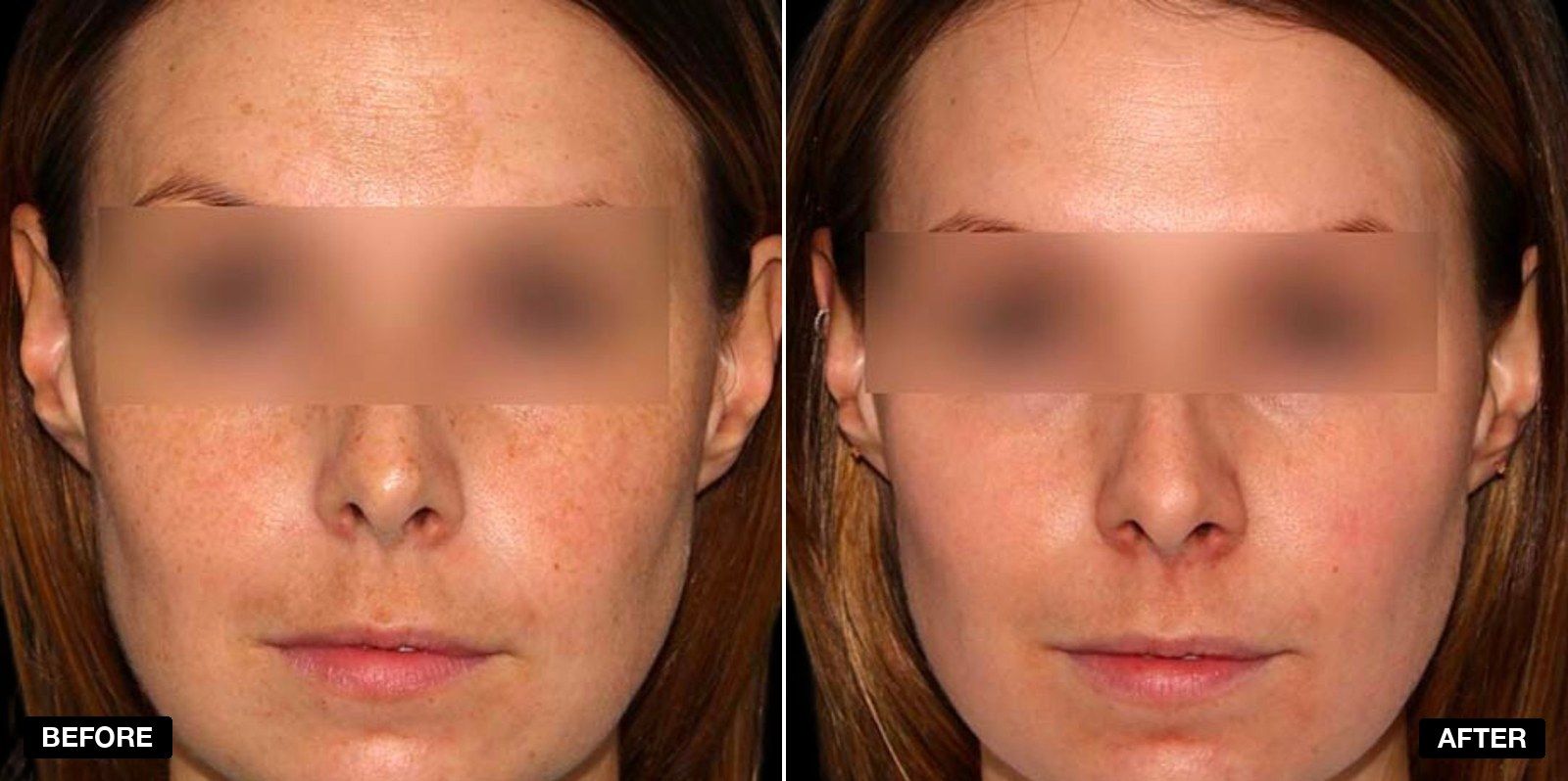 Before and after skin care treatments - patient case 4 of 5 at PHI Clinic London