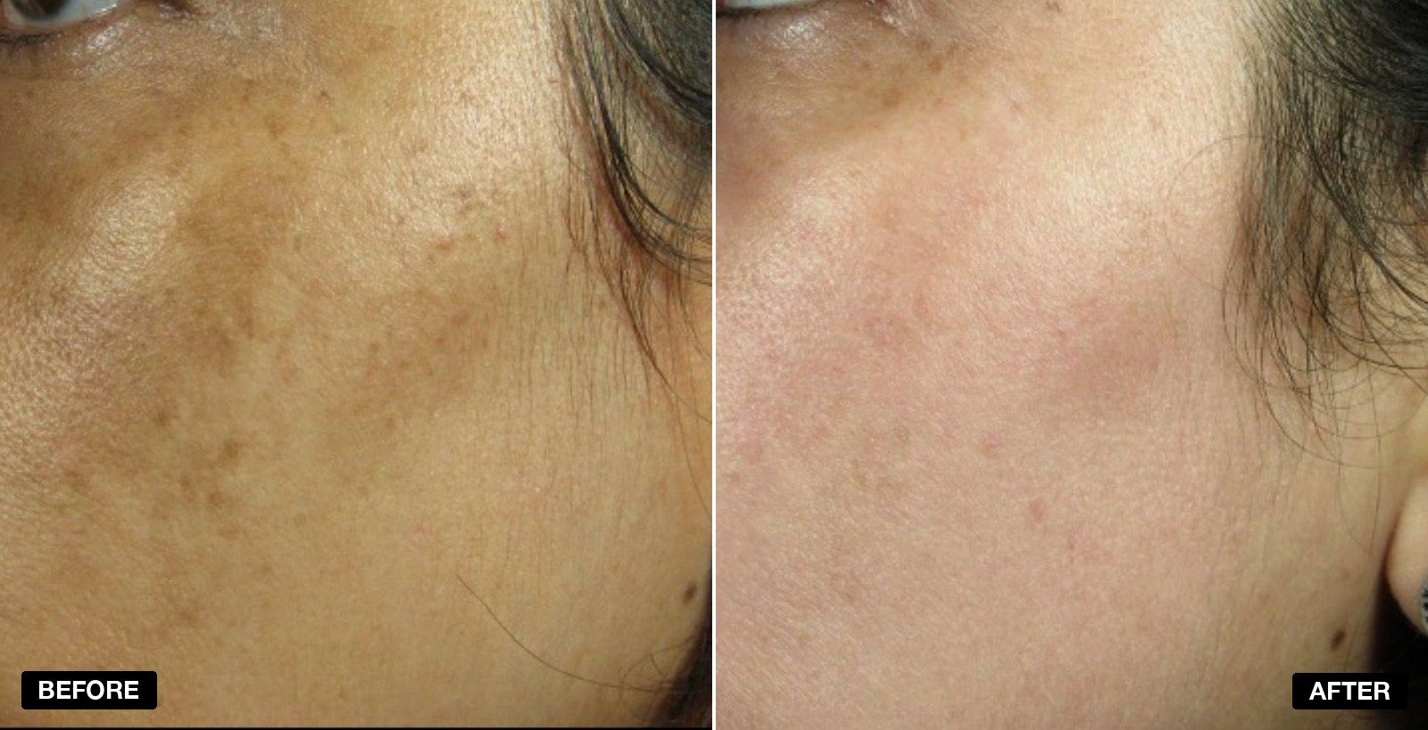 Before and after skin care treatments - patient case 5 of 5 at PHI Clinic London