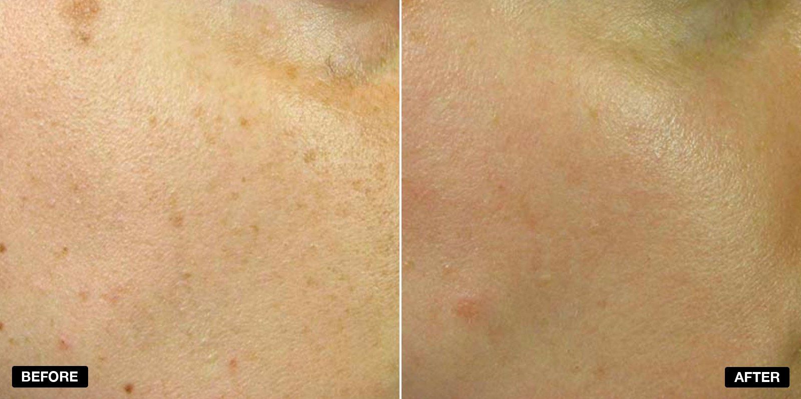 Before and after treatment - patient case 2 of 5 at PHI Clinic London