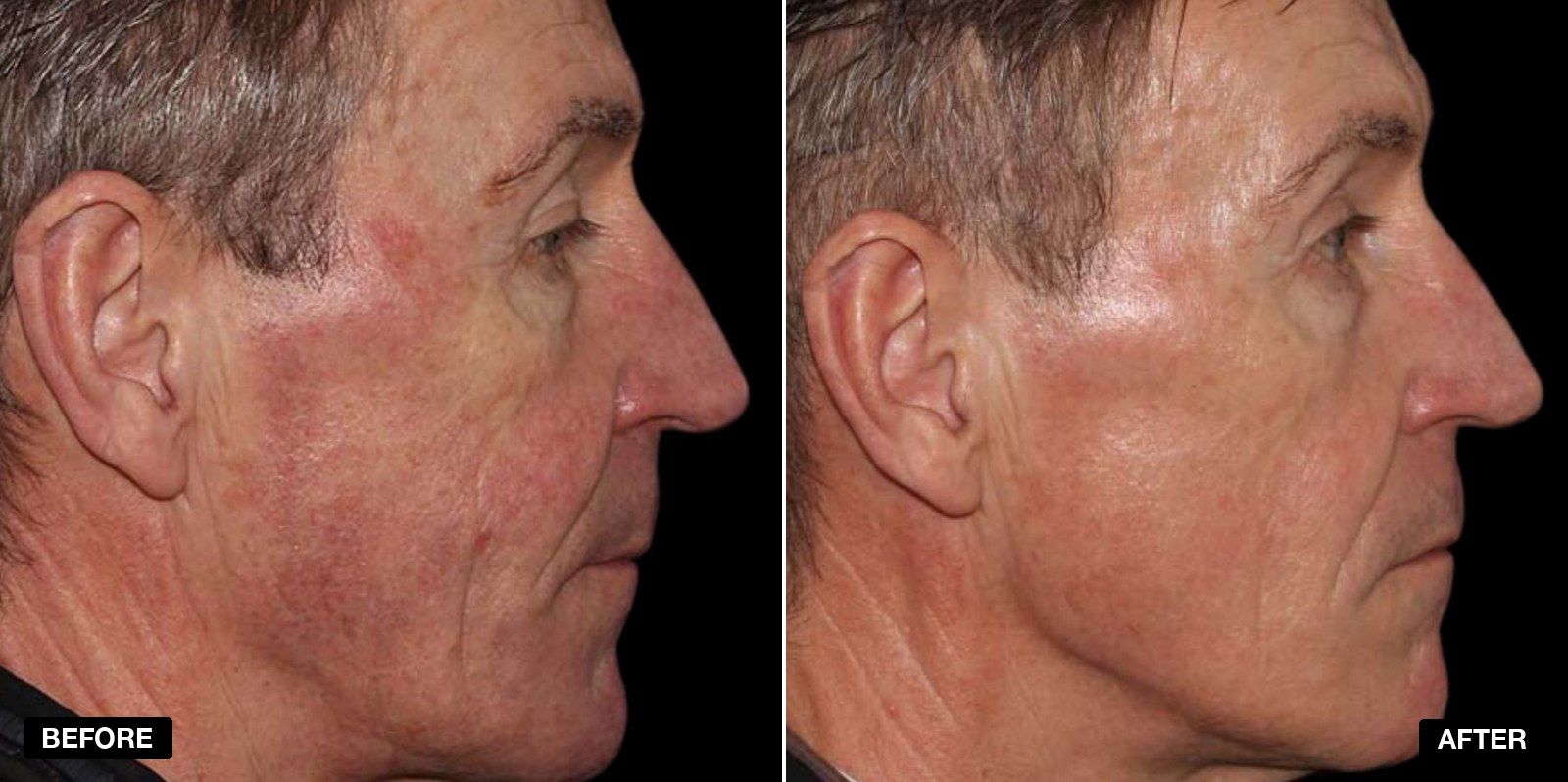 Before and after treatment - patient case 4 of 5 at PHI Clinic London
