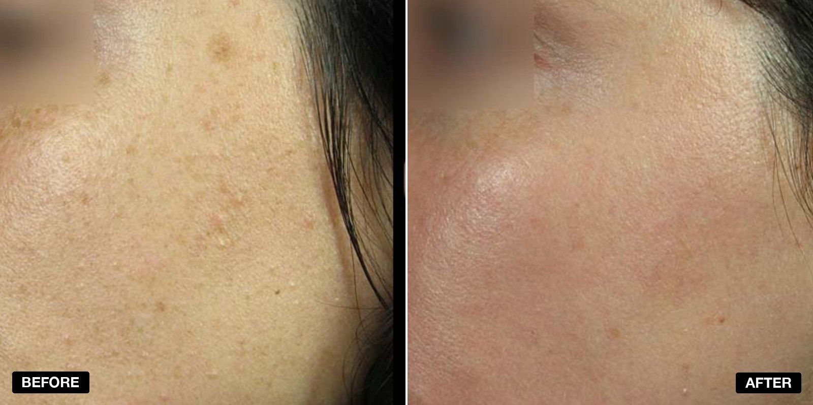 Before and after treatment - patient case 5 of 5 at PHI Clinic London