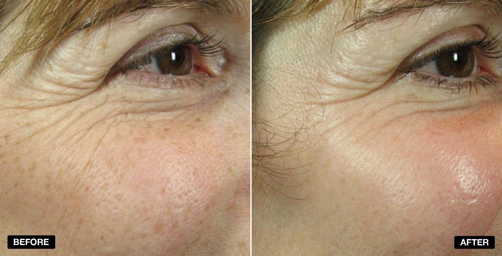 Botox before and after crows feet - patient case 1 of 1 at PHI Clinic London