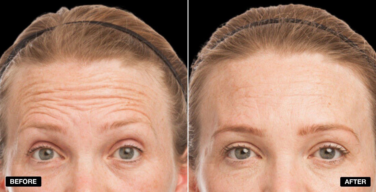 Botox before and after forehead - patient case 2 of 2 at PHI Clinic London