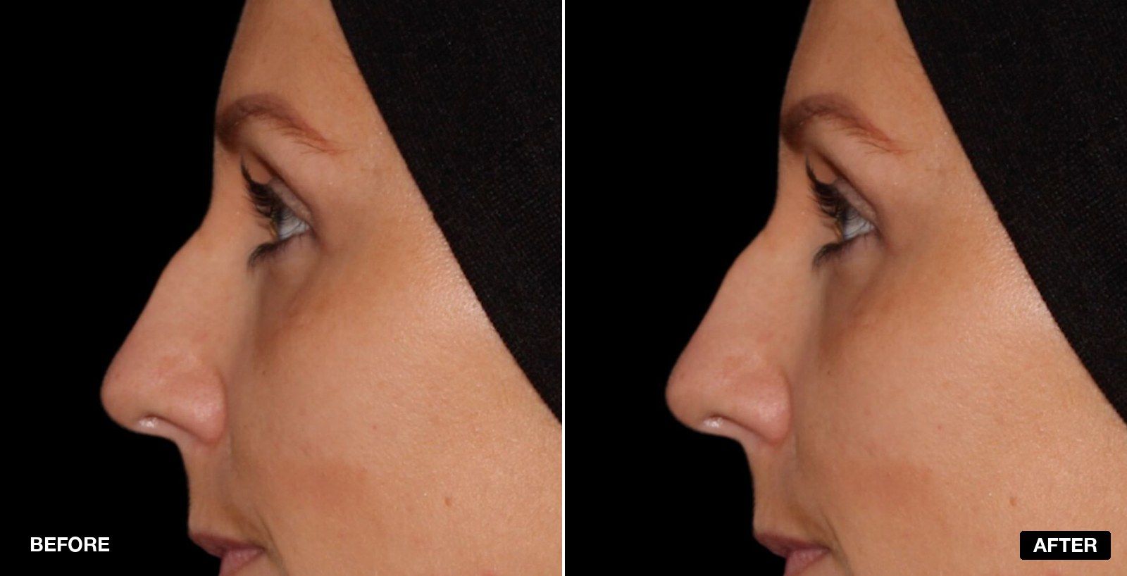 Bump on nose before & after Images - patient case 2 of 3 at PHI Clinic London