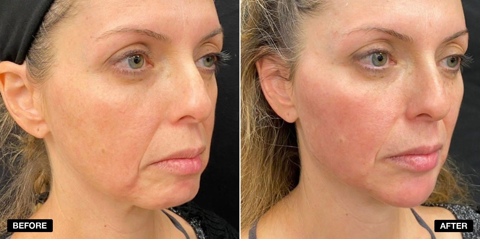 Cheek filler transformation - patient case 1 of 1 at PHI Clinic London