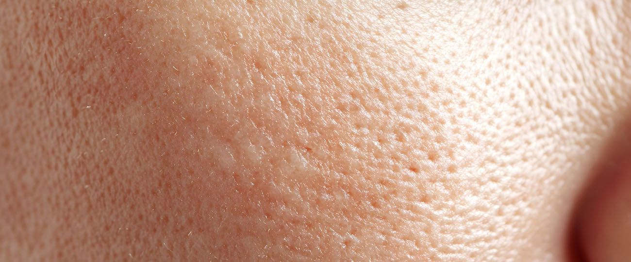 cheek skin treatment london