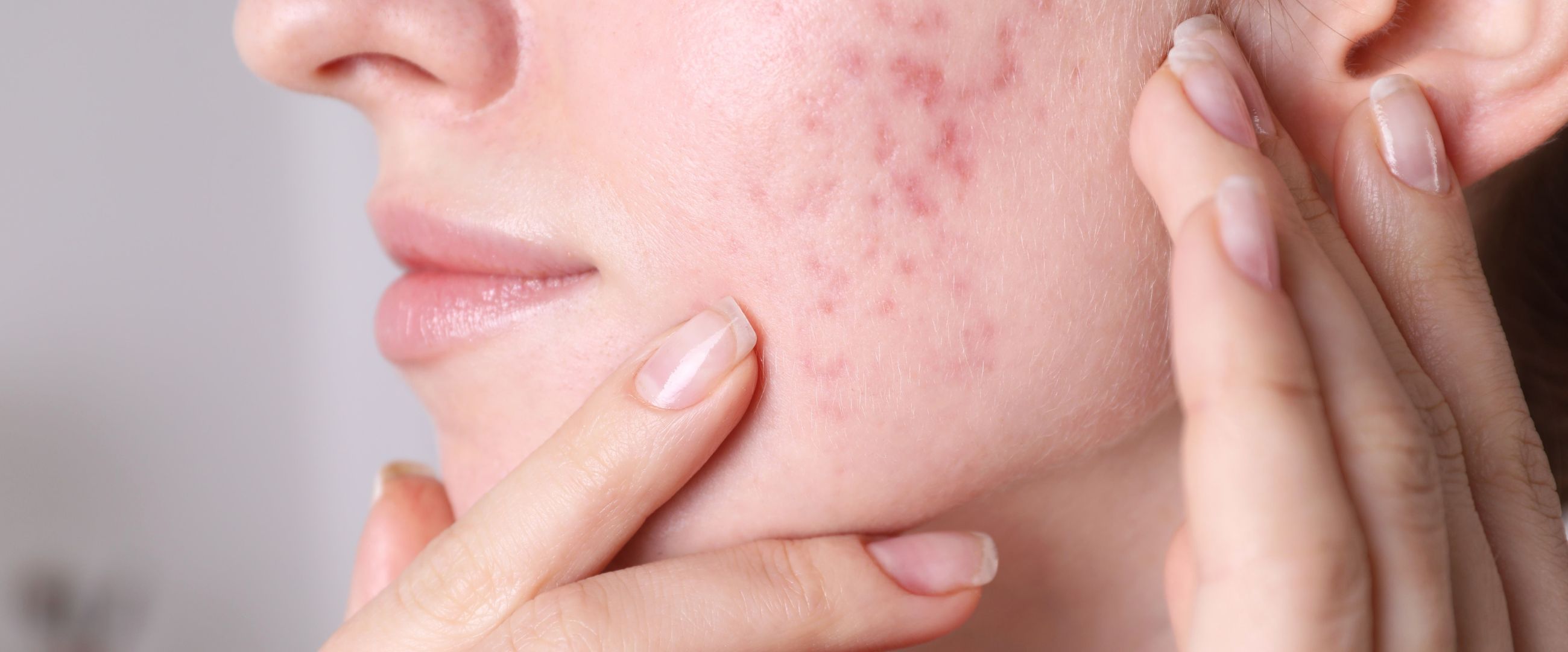 close up of woman with redness from acne