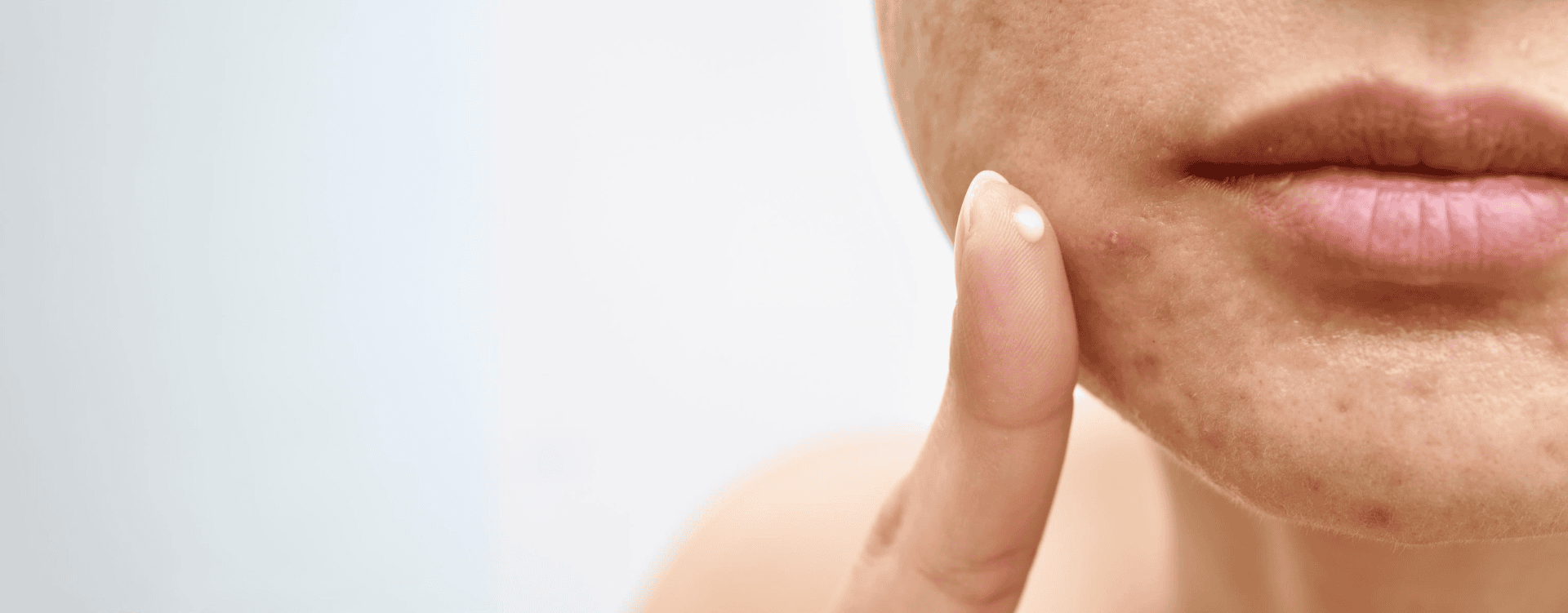 cystic acne
